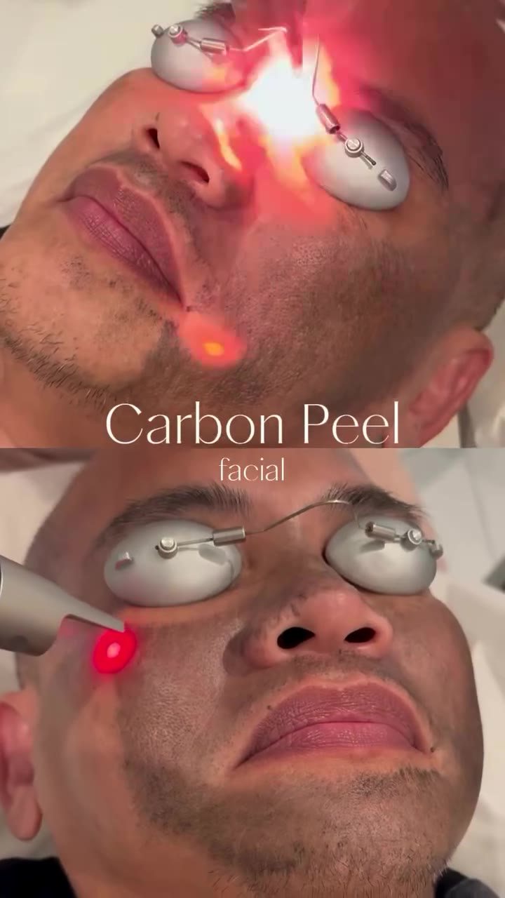 See the Pico Carbon Laser in action. ✨ No filters. Just real skin + advanced laser technology. #vlinecosmeticclinic #medspa #vline #hol...