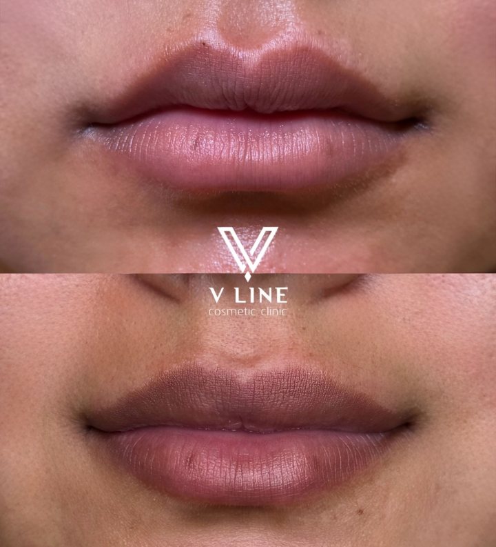 💋 Look at that top lip! 👀✨ A lip flip is a subtle treatment that helps relax the upper lip for a softer, more defined look. Somet...