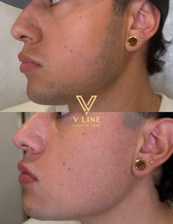 Laser Hair Removal | Beard Before & After Our client’s beard laser hair removal journey has made a noticeable difference in unwanted ha...