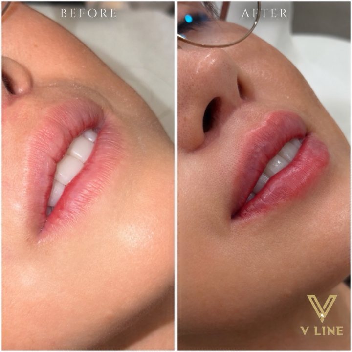 A little enhancement, still completely you. @nurse_trinh At V Line, our advanced injectors believe in a conservative, natural approach. C...