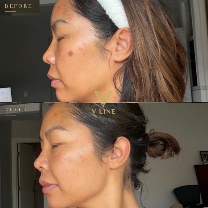 PicoSure Pro before & after ✨ This result was achieved after 3 session. PicoSure Pro uses picosecond laser technology to target unwante...