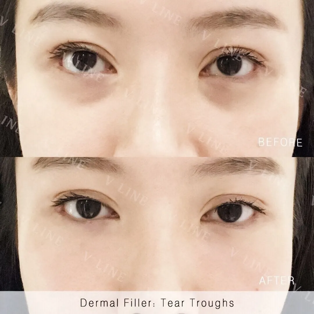 Dermal Fillers Before & After Gallery - Patient 133227325 - Image 1