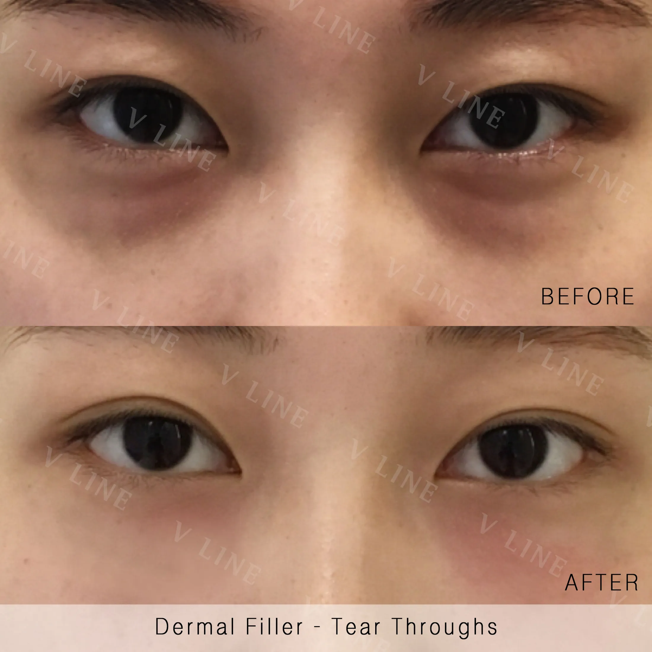 Dermal Fillers Before & After Gallery - Patient 133227324 - Image 1