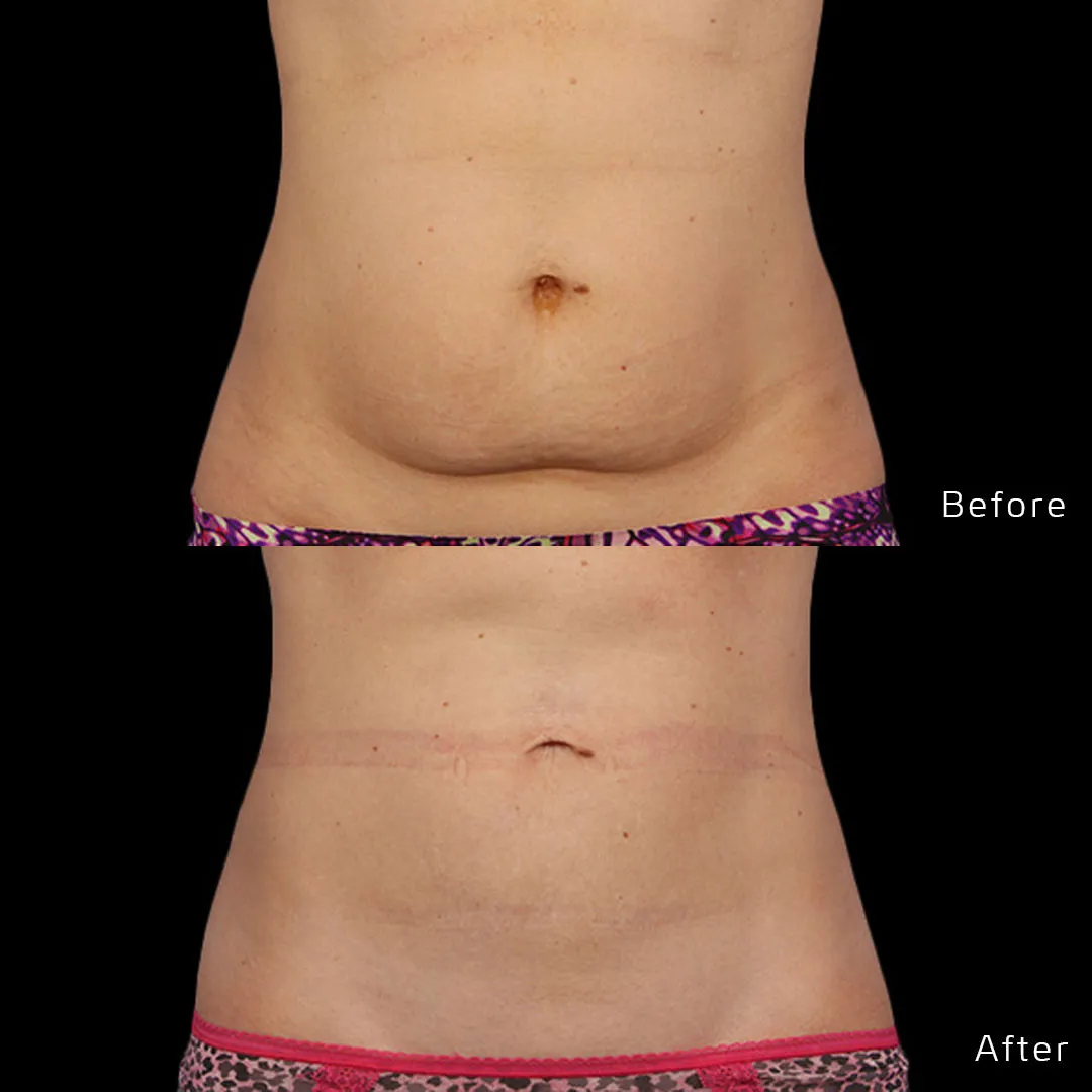 CoolSculpting Before & After Gallery - Patient 133227393 - Image 1