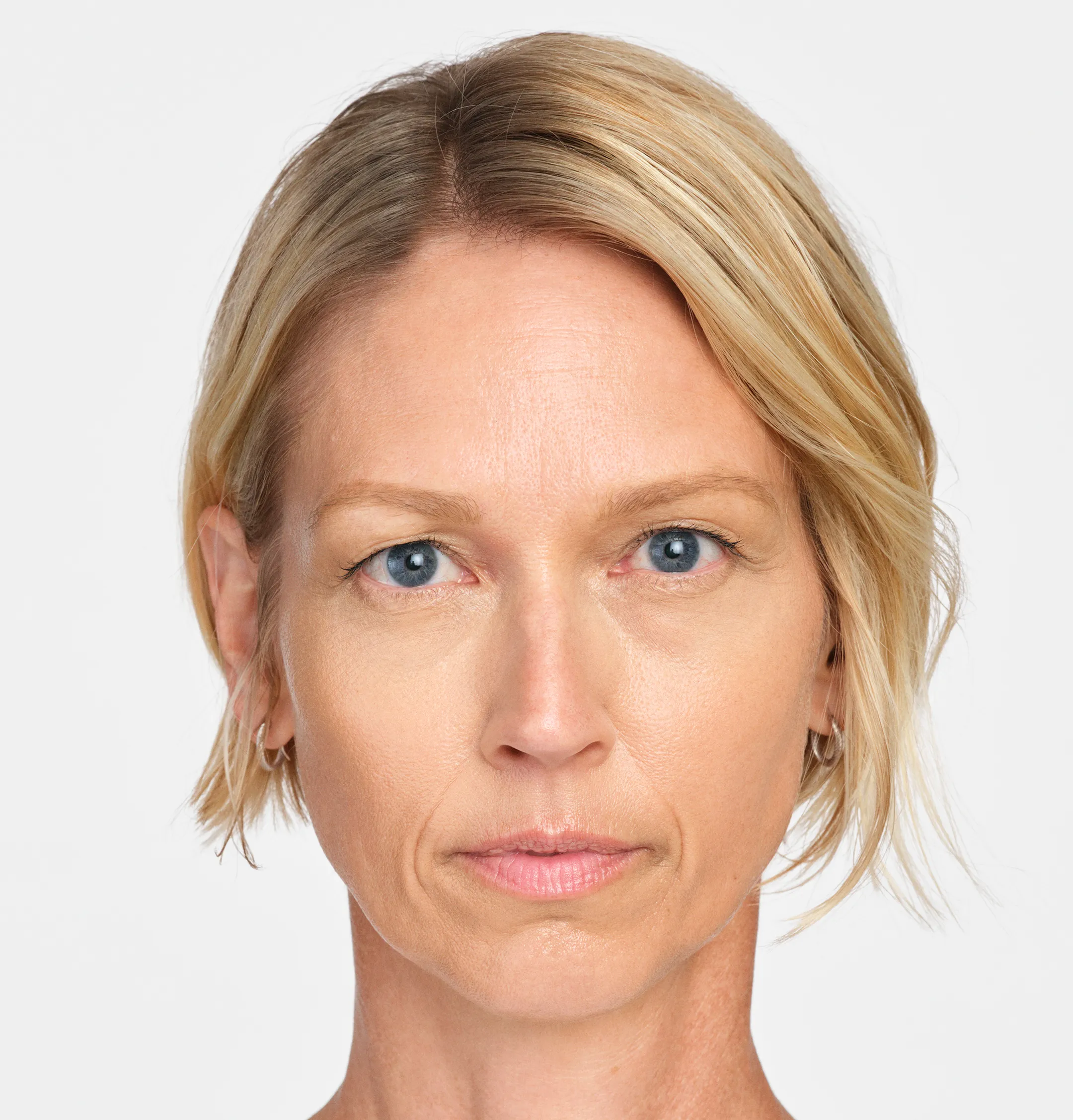Jackie Front - After Radiesse Treatment