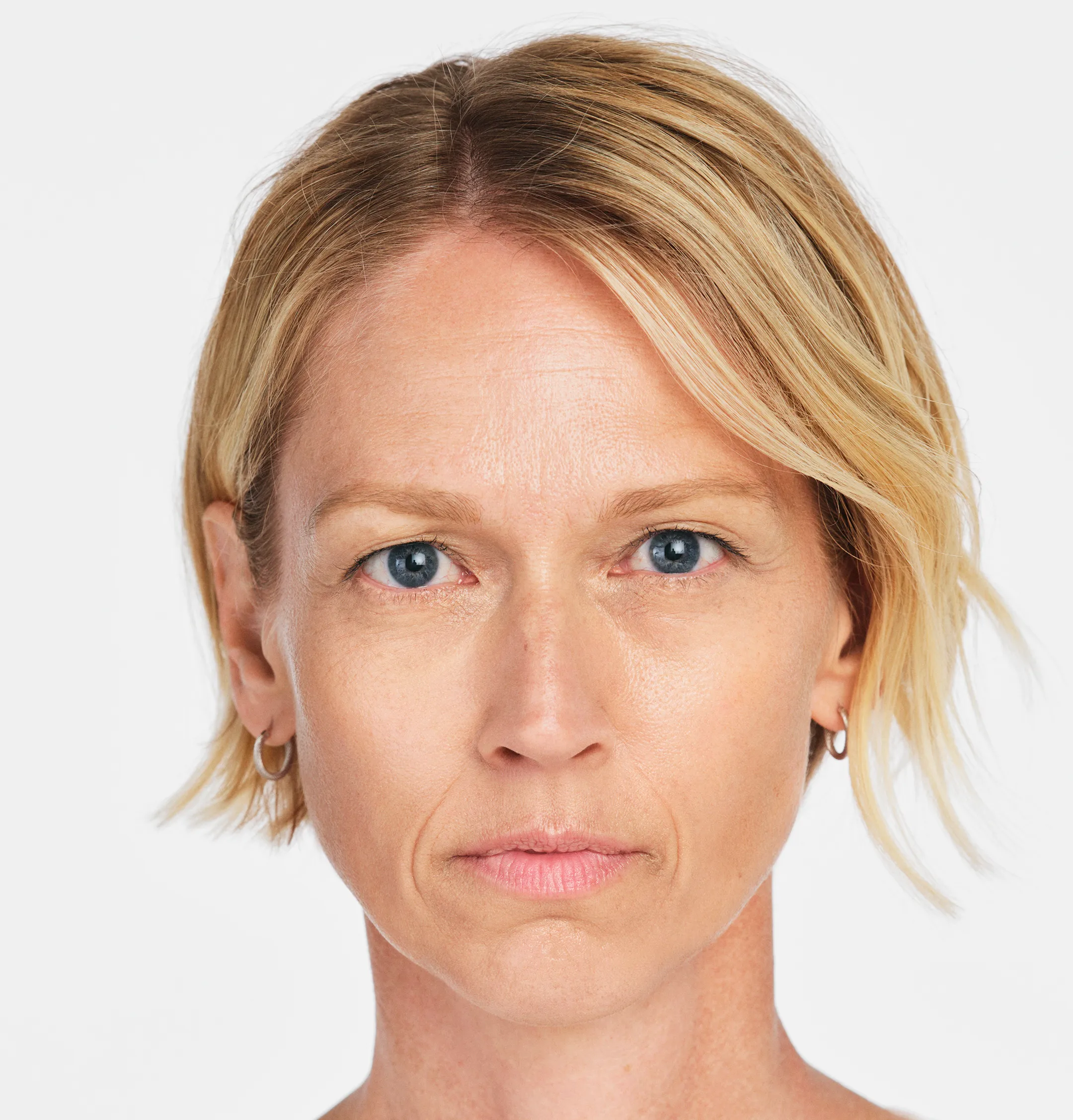 Jackie Front - Before Radiesse Treatment