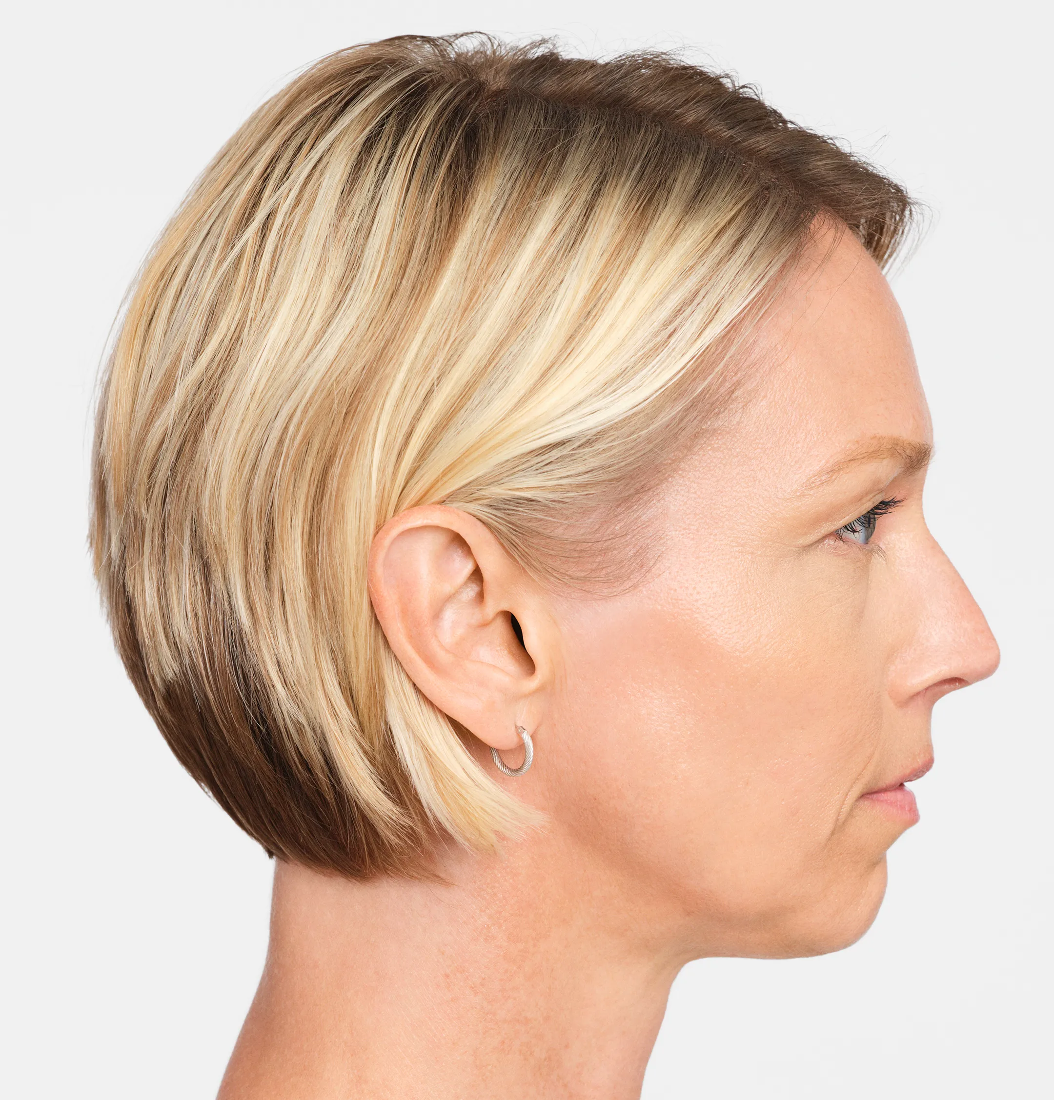 Jackie Profile - After Radiesse Treatment