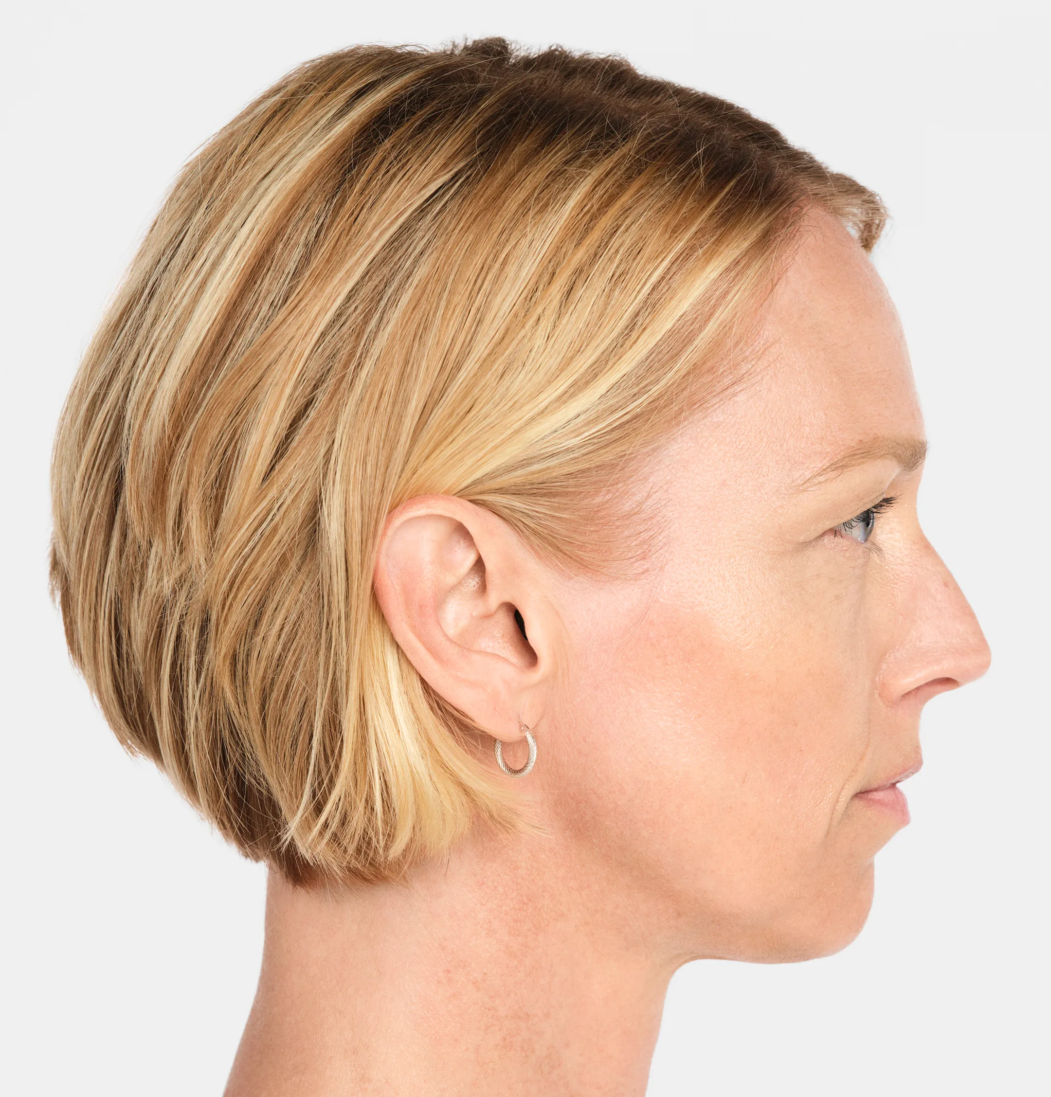 Jackie Profile - Before Radiesse Treatment